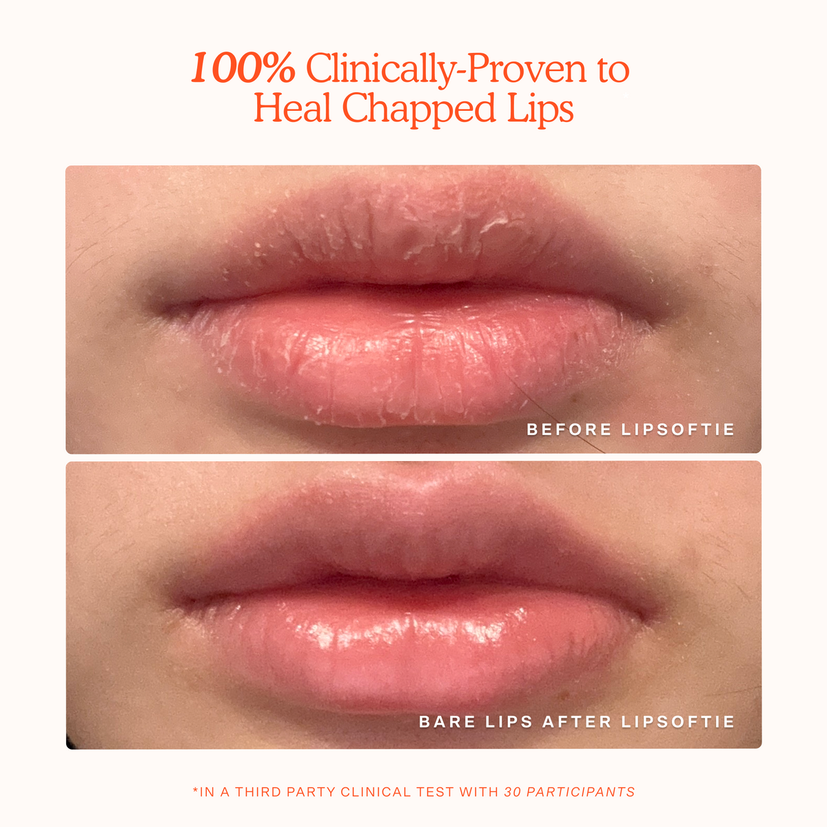 LipSoftie® Lip Treatment B0