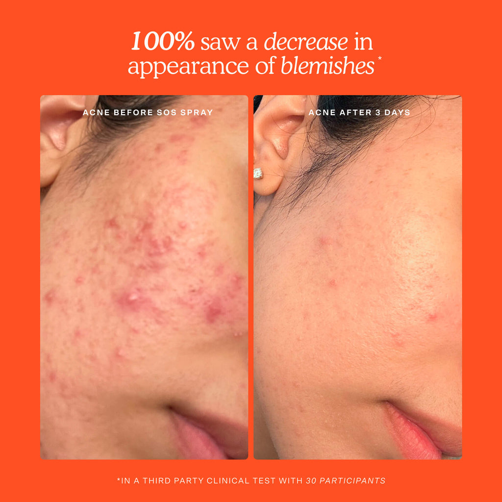 SOS Skincare Minis Kit K3